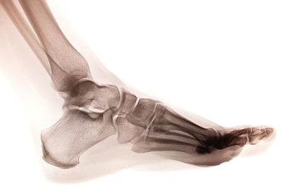 Plantar Fascia Tears in NFL Athletes: Why it Happens & How It's Treated