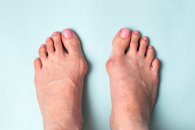 How To Relieve Bunion Pain Without Surgery