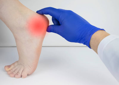 What Is Calcaneal Bursitis