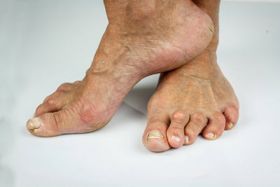 What Causes Hammer Toe?