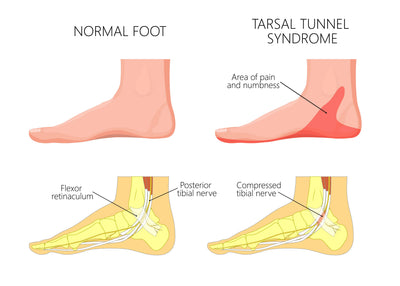 Common Causes of Tarsal Tunnel Syndrome
